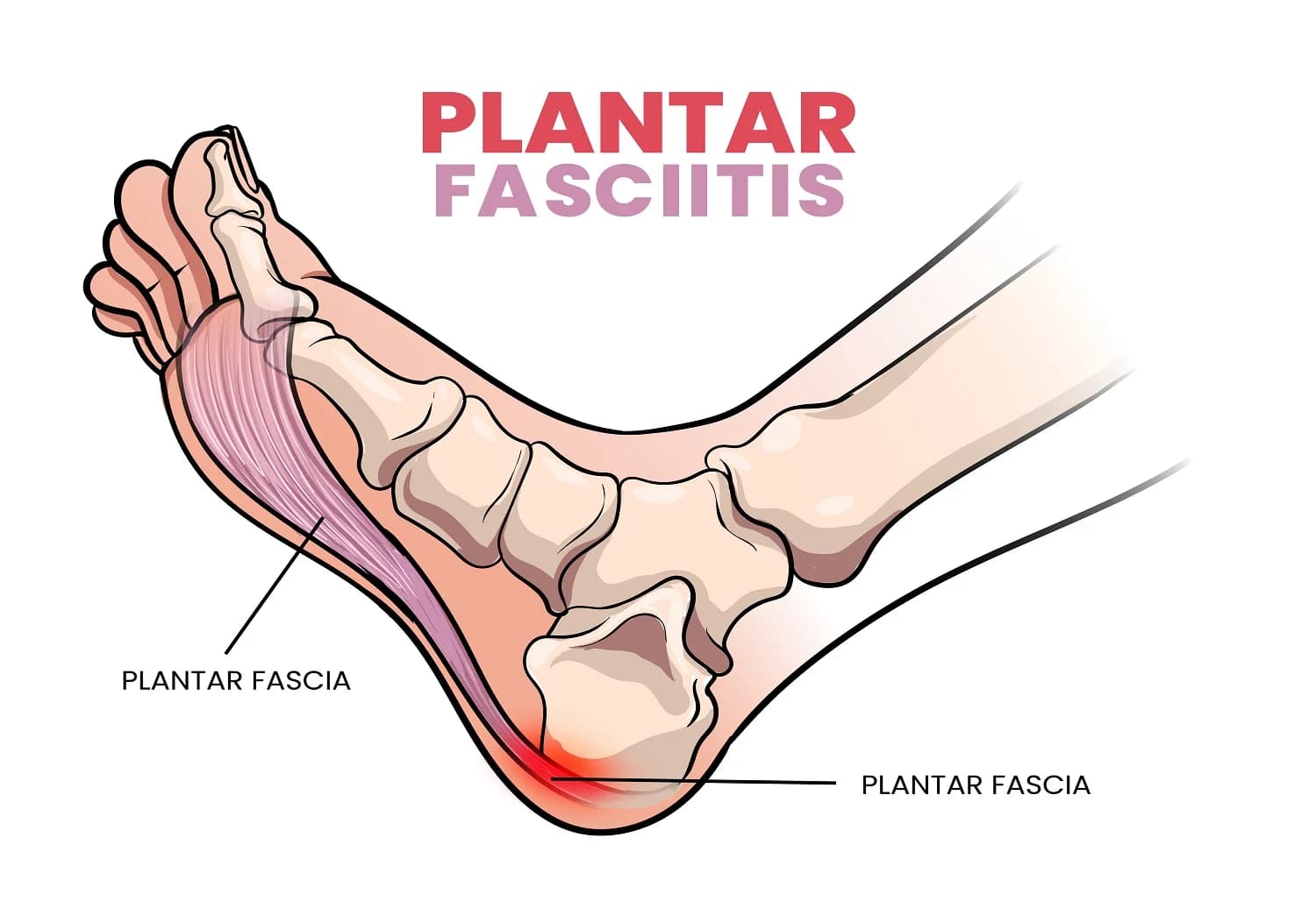Medical diagram of human foot showing bones, muscles, and highlighted plantar fascia ligament with red inflamed area at the heel